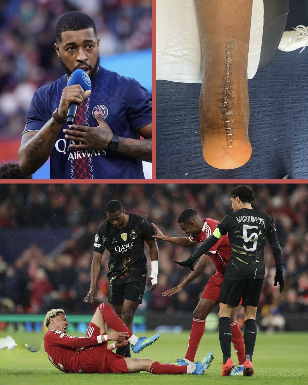 Ekitike futbolda ən ağır sayılan zədəni alıb